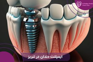 ایمپلنت دندان در تبریز