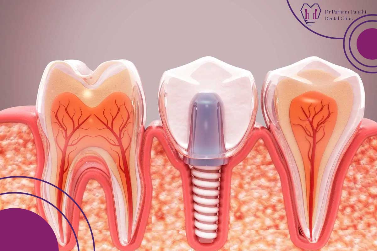 کاشت دندان در تبریز