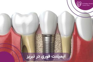 ایمپلنت فوری در تبریز