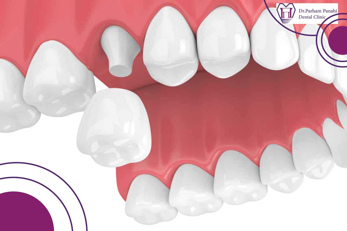 مزایای ایمپلنت دندان نسبت به روکش