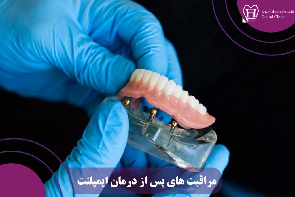 مراقبت‌های پس از درمان ایمپلنت