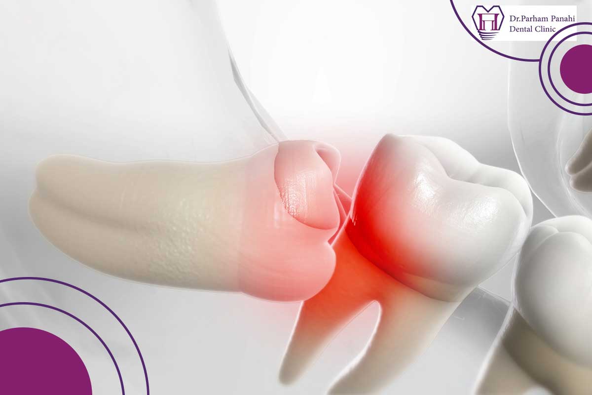 دستورالعملهای مراقبتی بعد از جراحی دندان عقل نهفته
