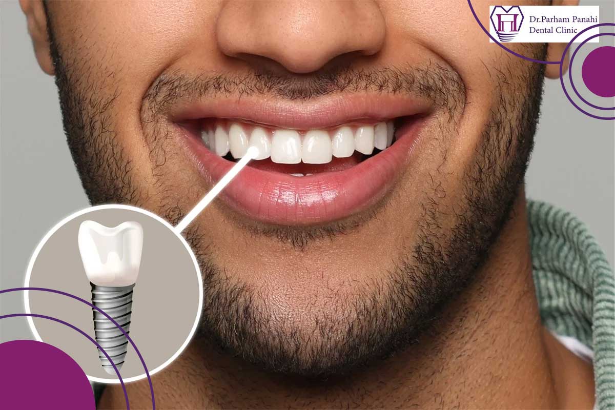 نکات ضروری مراقبت از ایمپلنت دندان