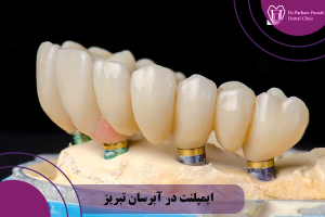 ایمپلنت در آبرسان تبریز