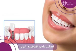 ایمپلنت دندان اقساطی در تبریز