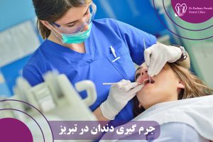 جرم گیری دندان در تبریز