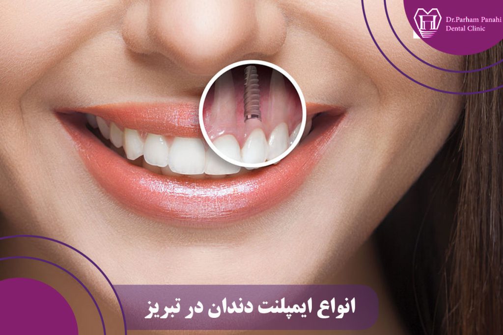 انواع ایمپلنت دندان در تبریز