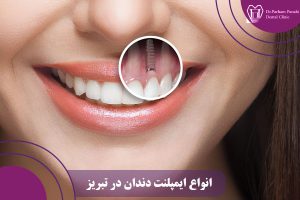 انواع ایمپلنت دندان در تبریز