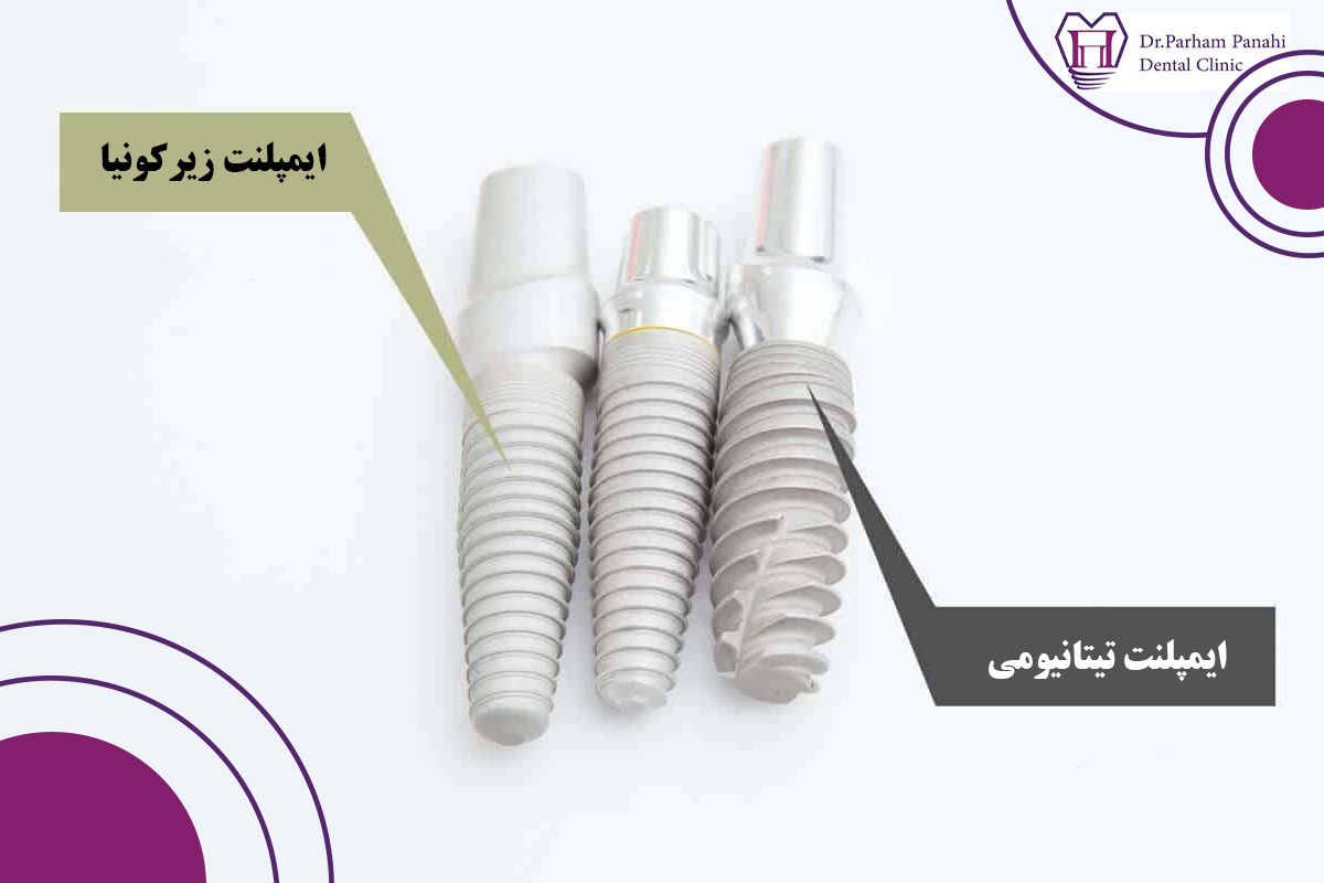 انواع ایمپلنت دندان از نظر جنس