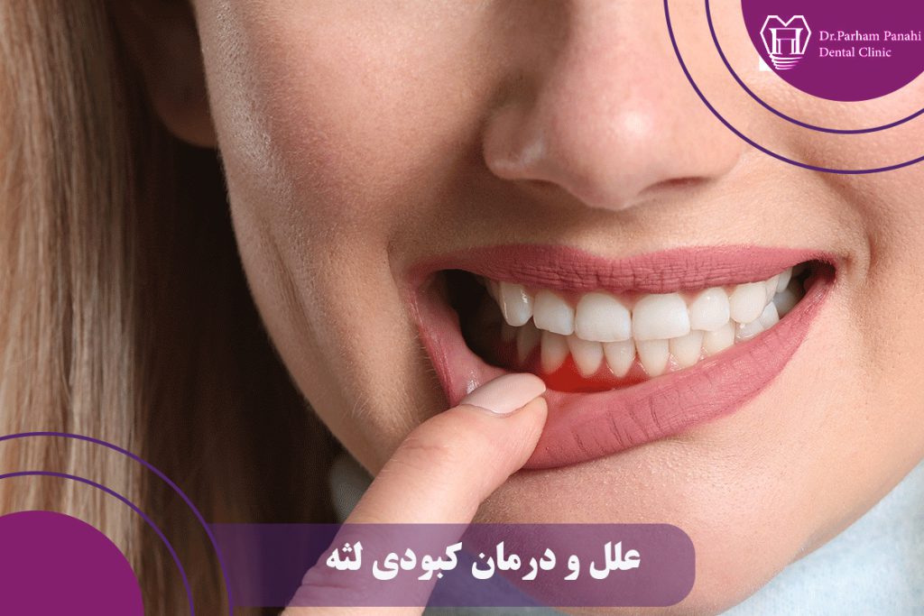 علل و درمان کبودی لثه
