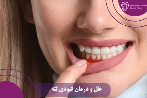 علل و درمان کبودی لثه