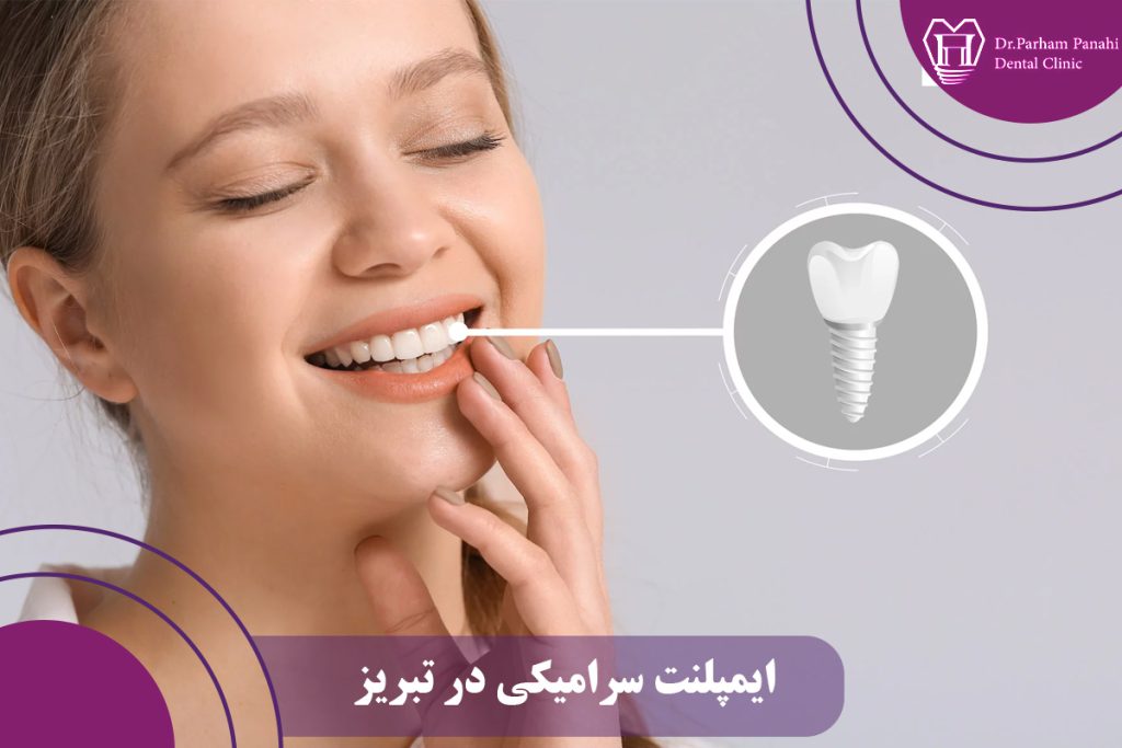 ایمپلنت سرامیکی در تبریز