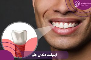 ایمپلنت دندان جلو