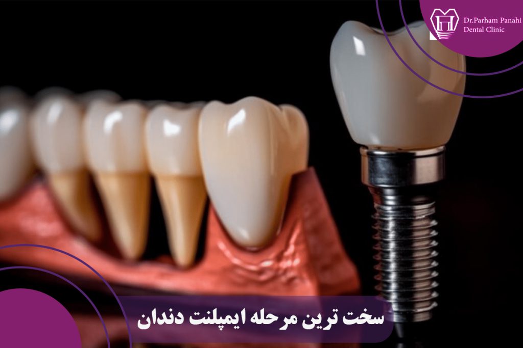 سخت ترین مرحله ایمپلنت دندان