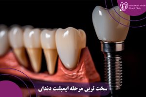 سخت ترین مرحله ایمپلنت دندان