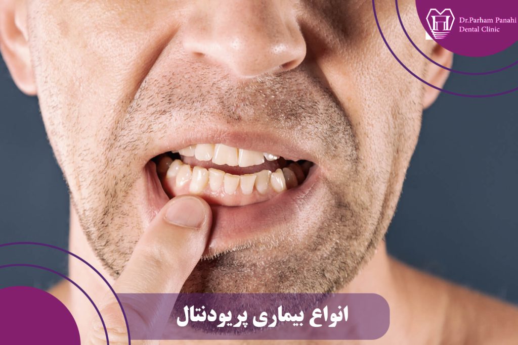 انواع بیماری پریودنتال