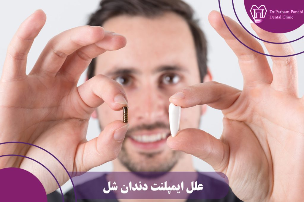 علل ایمپلنت دندان شل