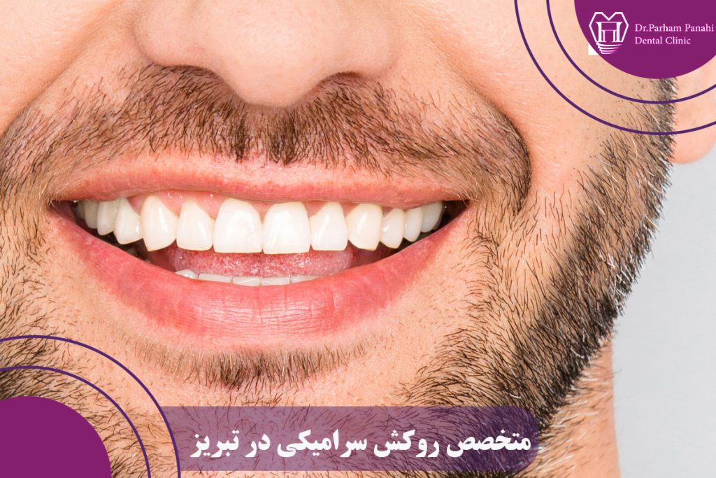 روکش سرامیکی در تبریز