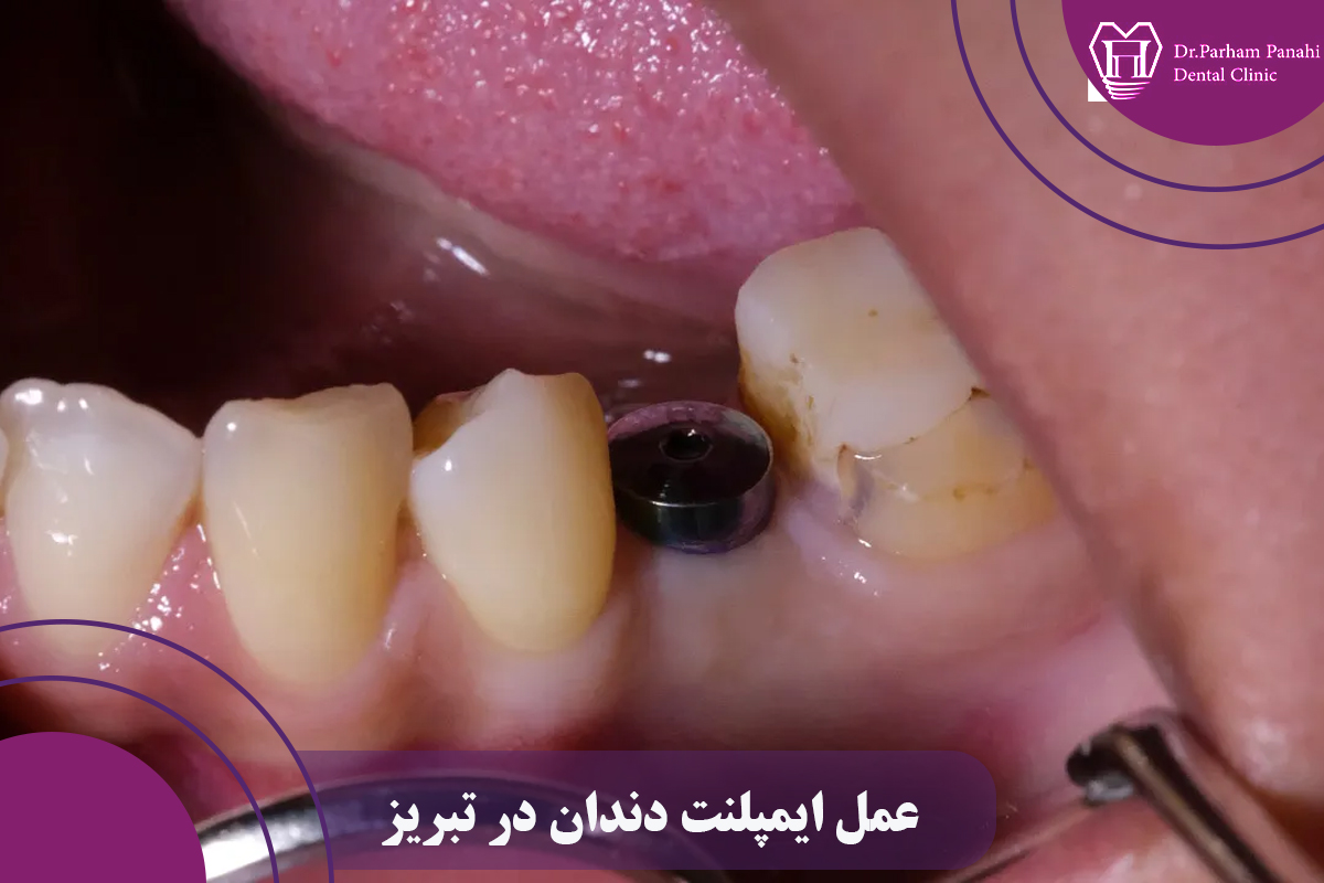 عمل ایمپلنت دندان در تبریز