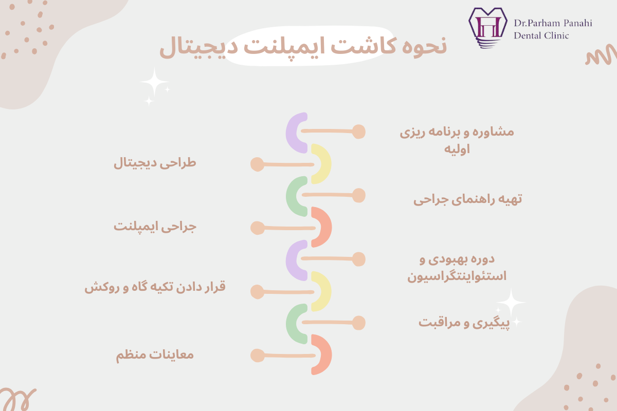 نحوه کاشت ایمپلنت دیجیتال