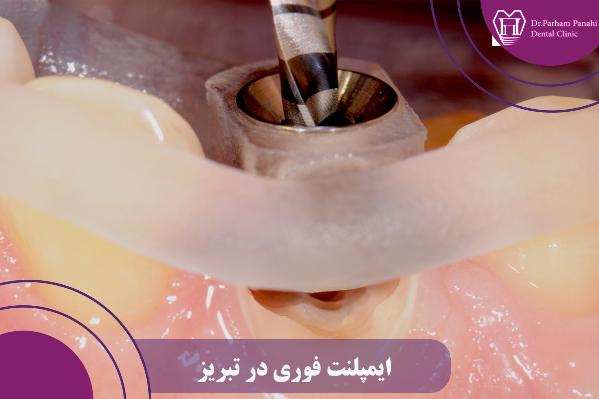 ایمپلنت فوری در تبریز
