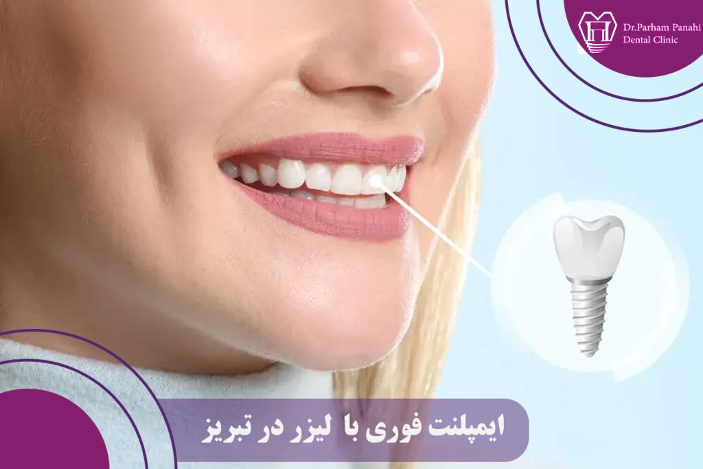 ایمپلنت فوری با لیزر در تبریز