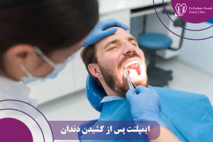 ایمپلنت پس از کشیدن دندان