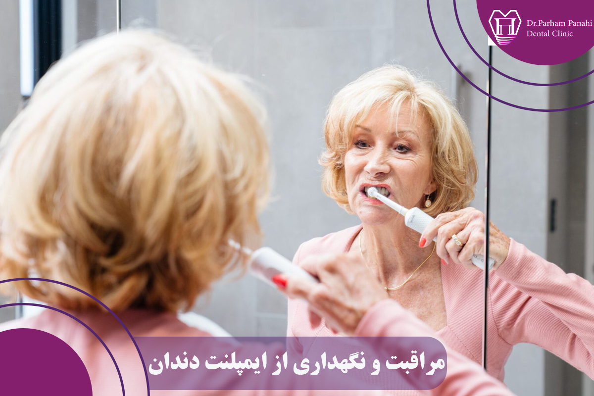 مراقبت و نگهداری طولانی مدت ایمپلنت دندان