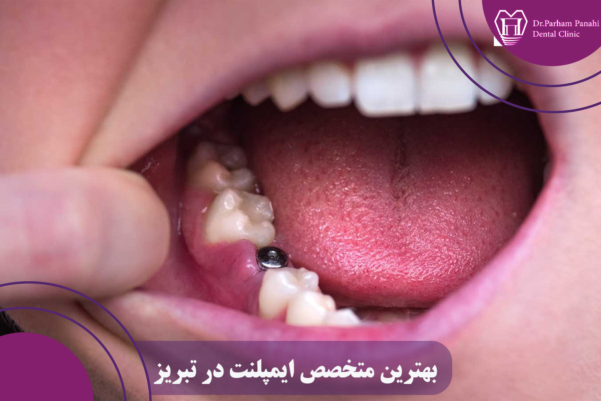 بهترین متخصص ایمپلنت در تبریز