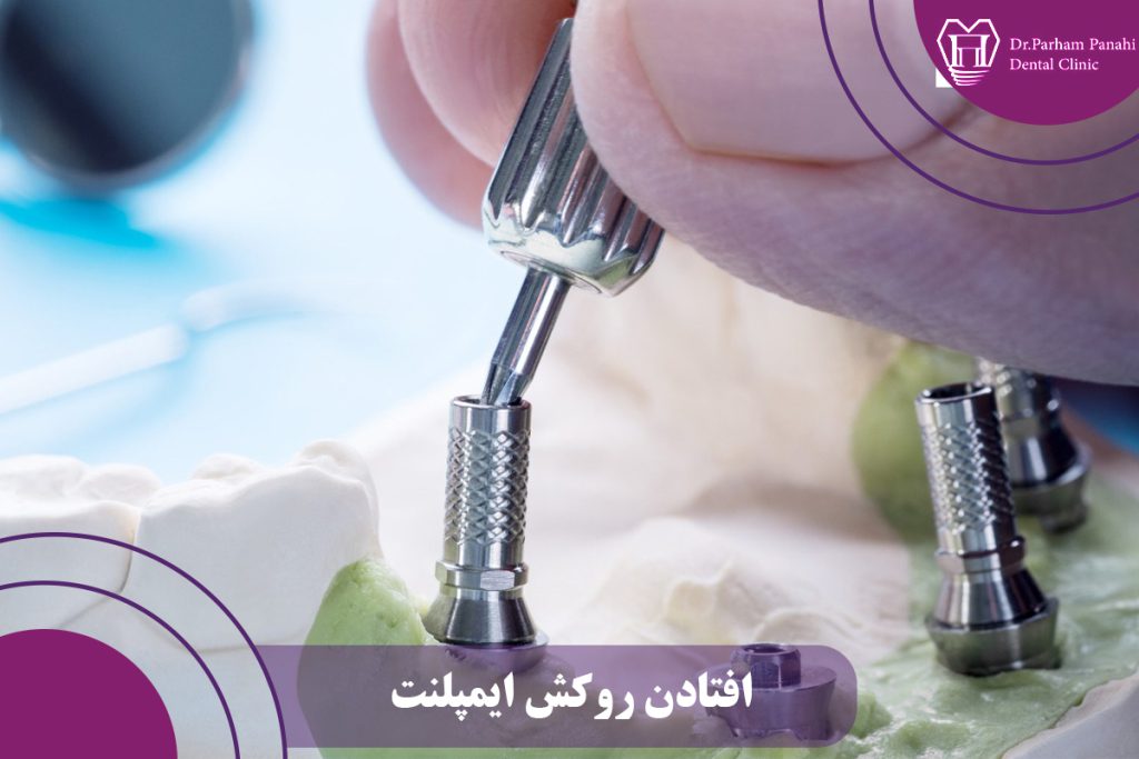افتادن روکش ایمپلنت