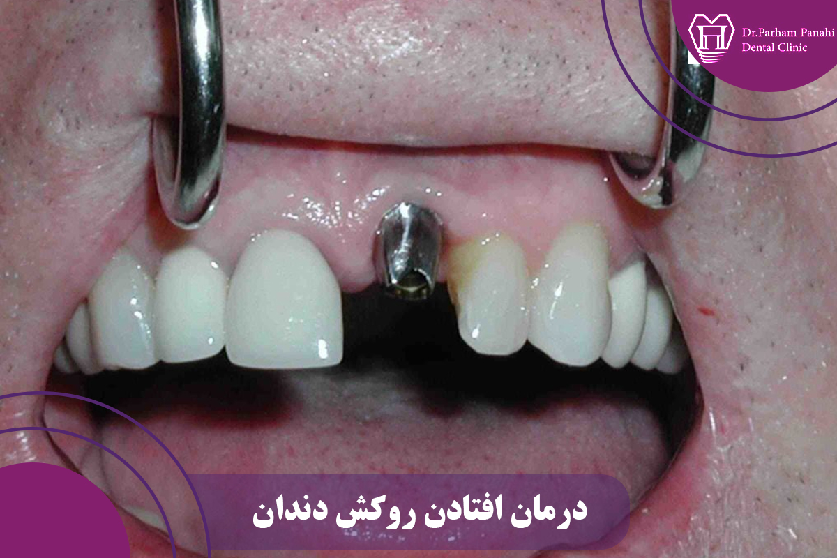 درمان افتادن روکش دندان