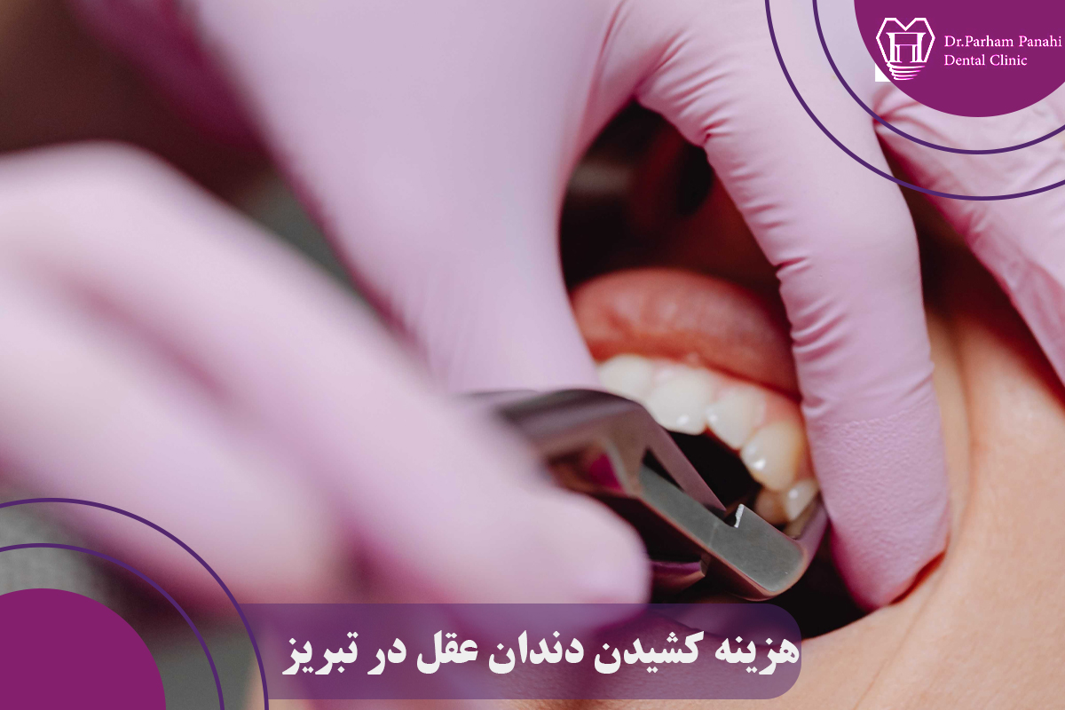 هزینه کشیدن دندان عقل در تبریز
