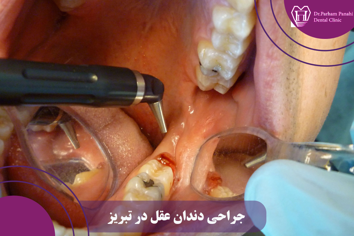 جراحی دندان عقل با لیزر در تبریز