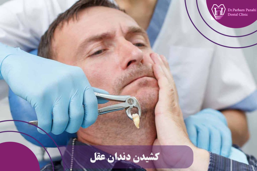 کشیدن دندان عقل