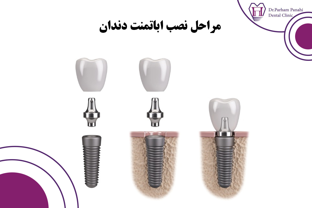 مراحل نصب اباتمنت دندان