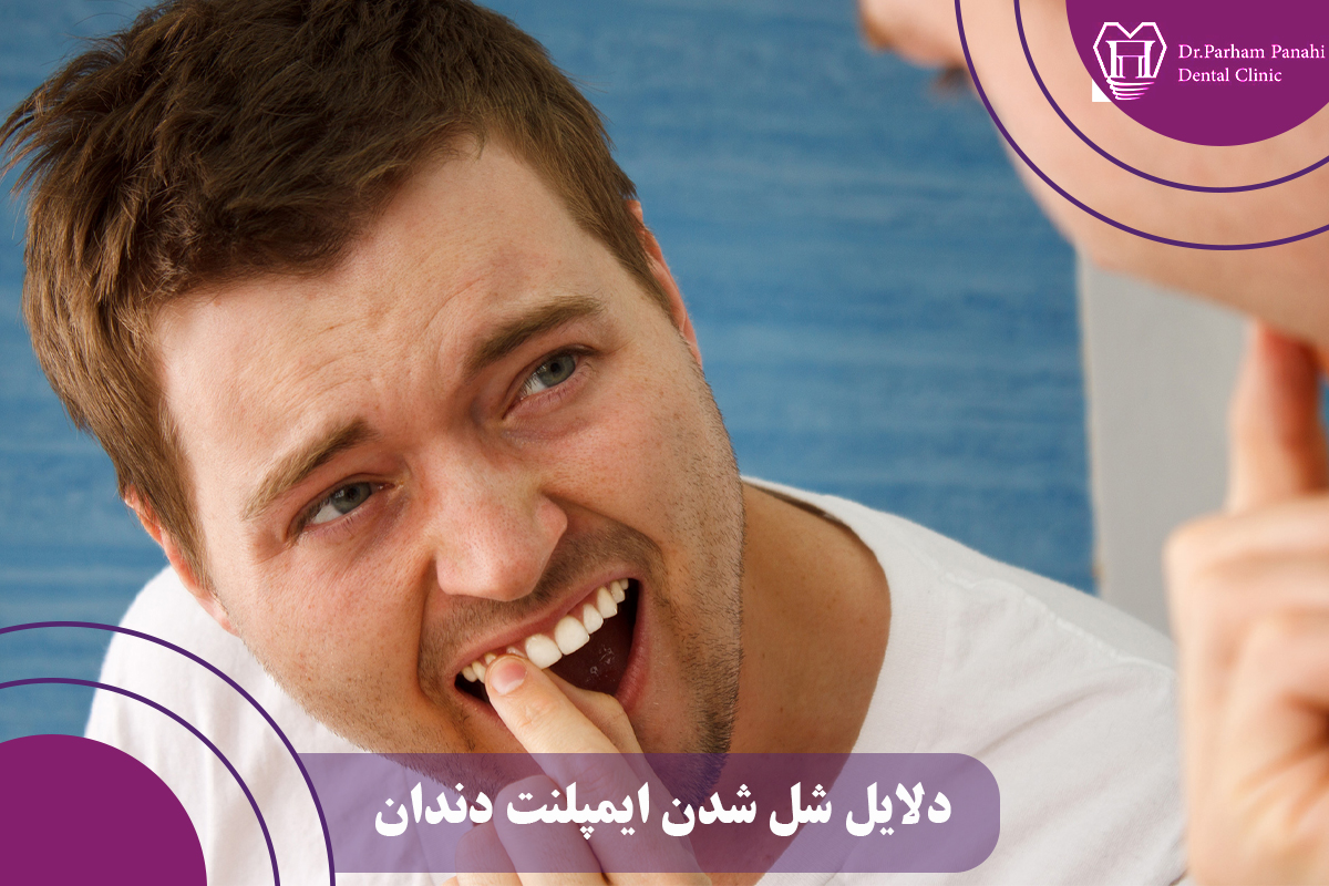 شل شدن ایمپلنت دندان 