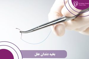 بخیه دندان عقل