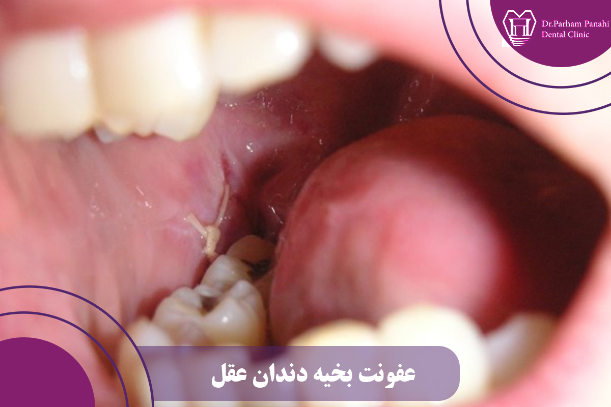 عفونت بخیه دندان عقل