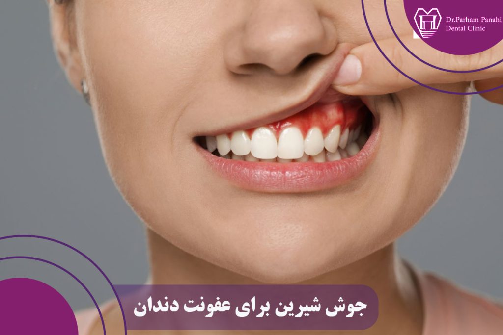 جوش شیرین برای عفونت دندان
