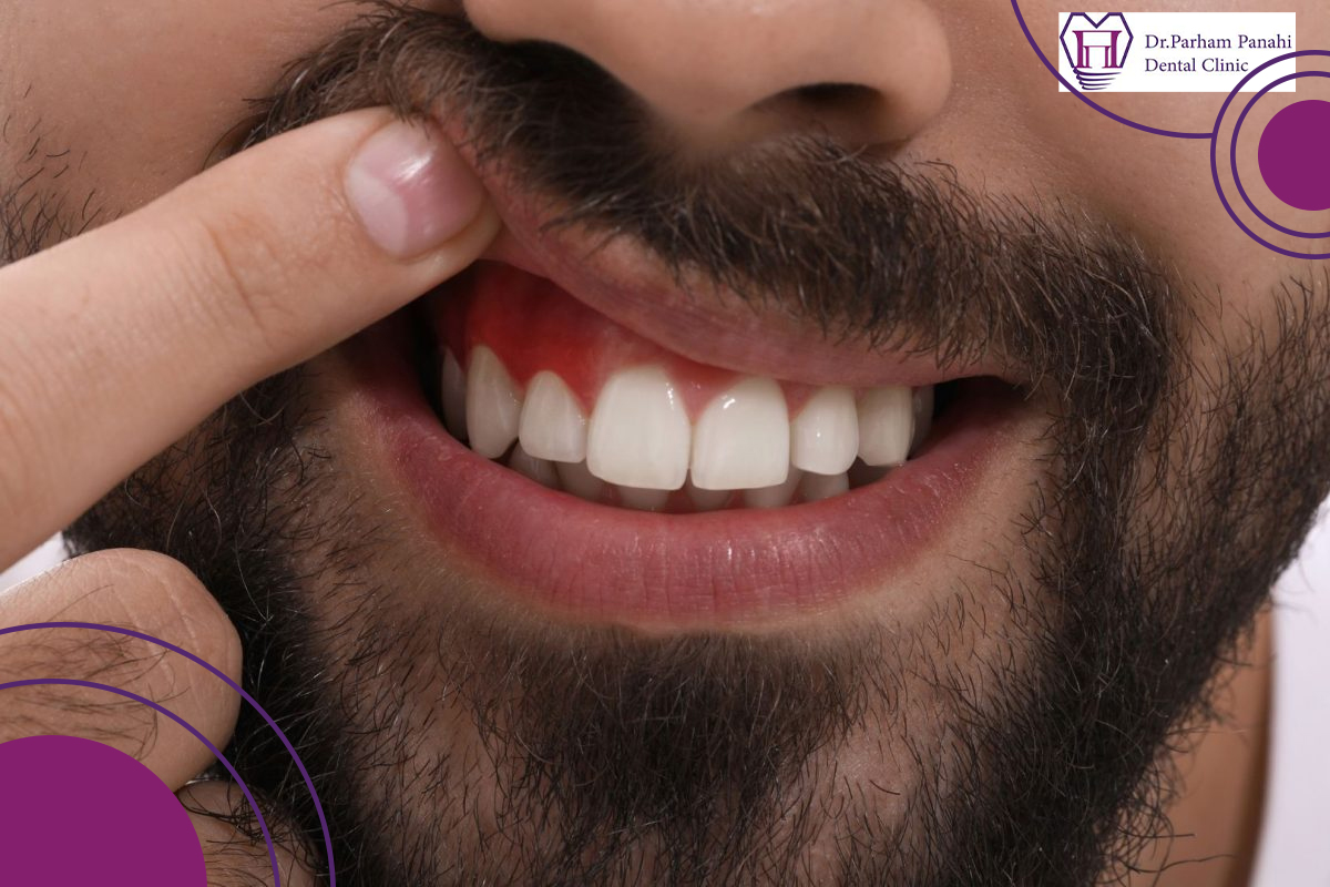 مزایای جراحی لثه در تبریز