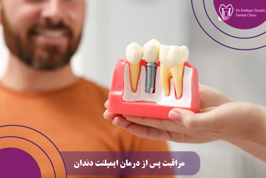 مراقبت پس از درمان ایمپلنت دندان