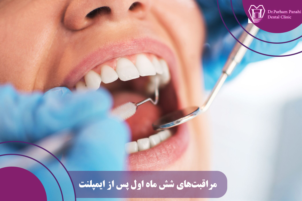 مراقبتهای شش ماه اول پس از ایمپلنت