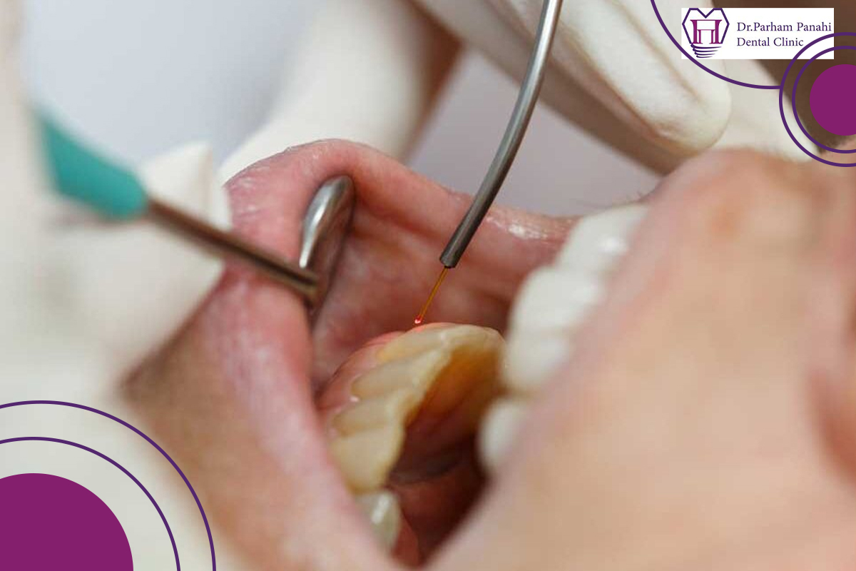 جراحی فلپ لثه در تبریز