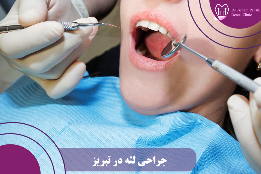 جراحی لثه در تبریز