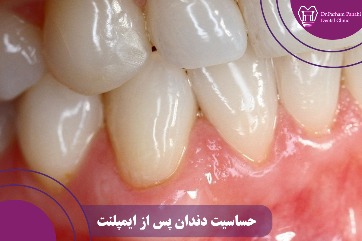 محل بروز حساسیت دندان پس از ایمپلنت