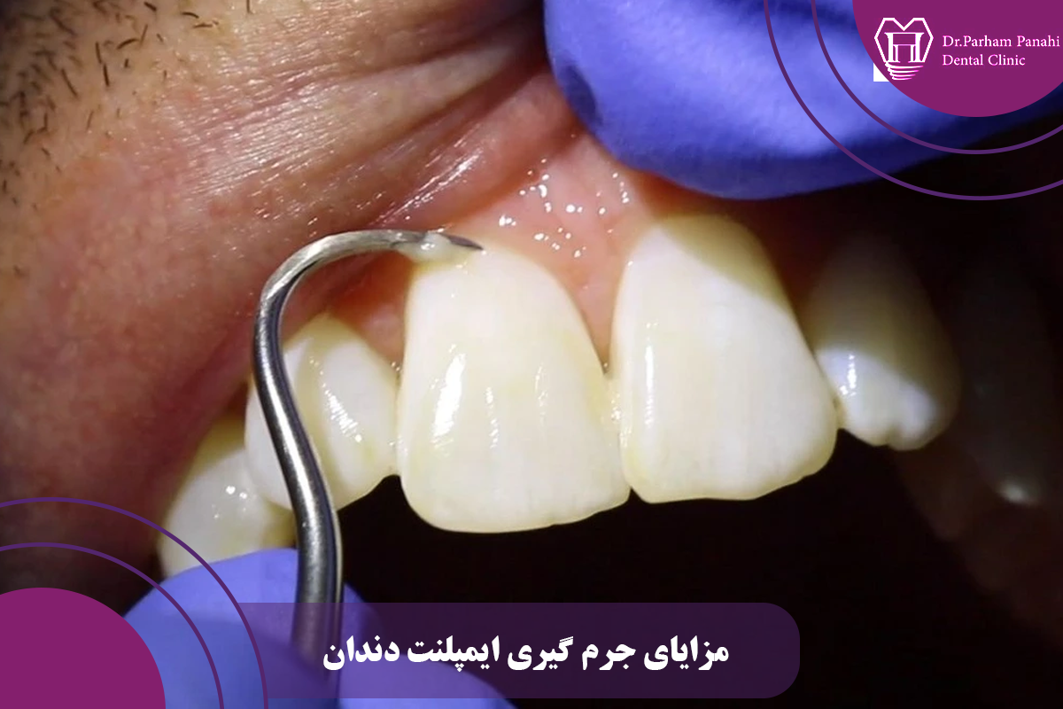 مزایای جرم گیری ایمپلنت دندان