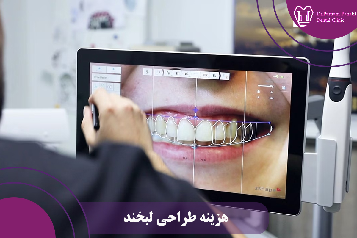 هزینه طراحی لبخند