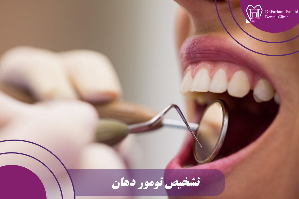 تشخیص تومور دهان