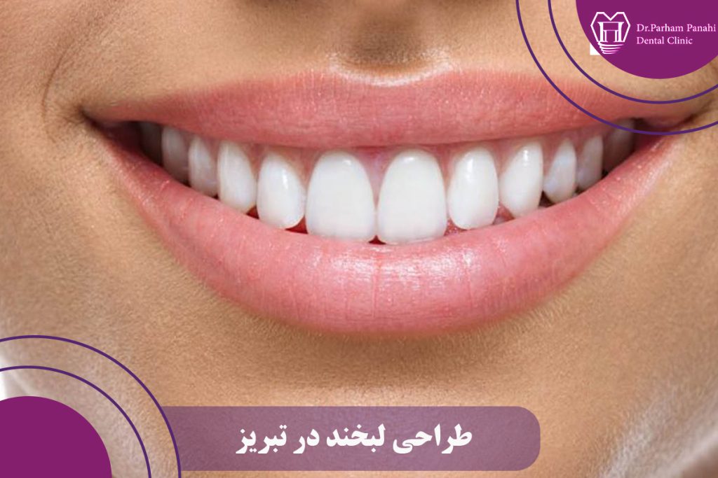 طراحی لبخند در تبریز