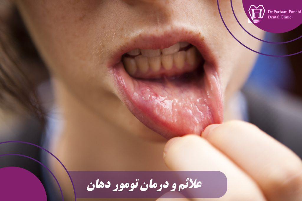 تومور دهان